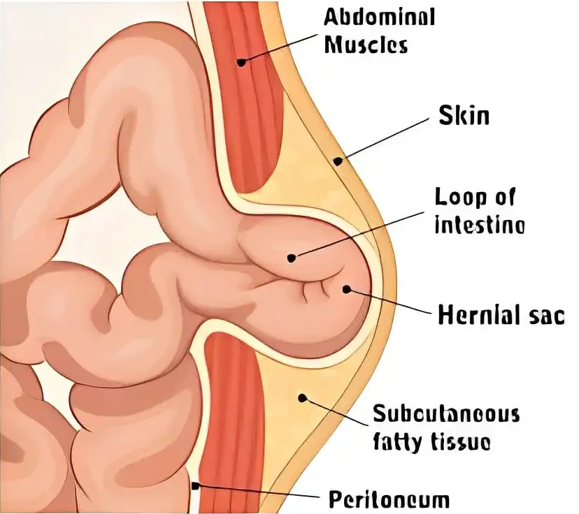 Umbilical Hernia in Adults
